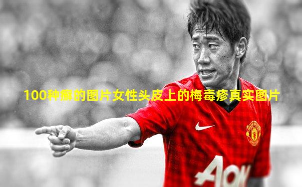 100种癣的图片女性头皮上的梅毒疹真实图片